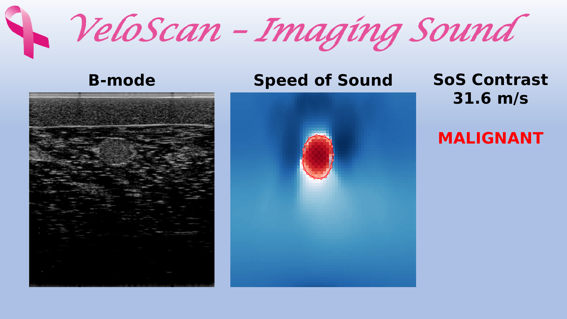 Sound-speed imaging example related to malignancy assessment